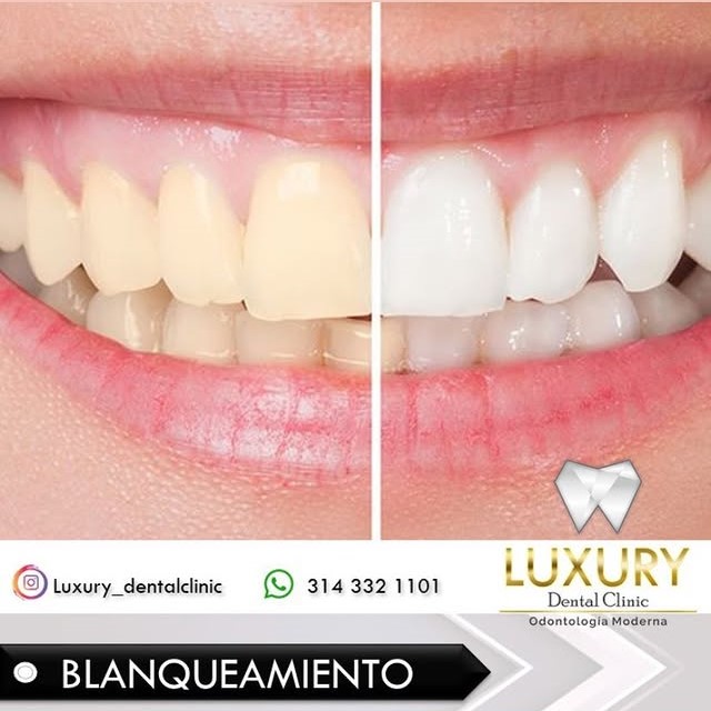 Blanqueamiento Dental