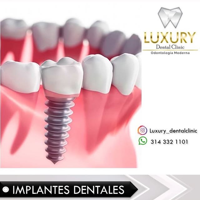 Implantes Dentales