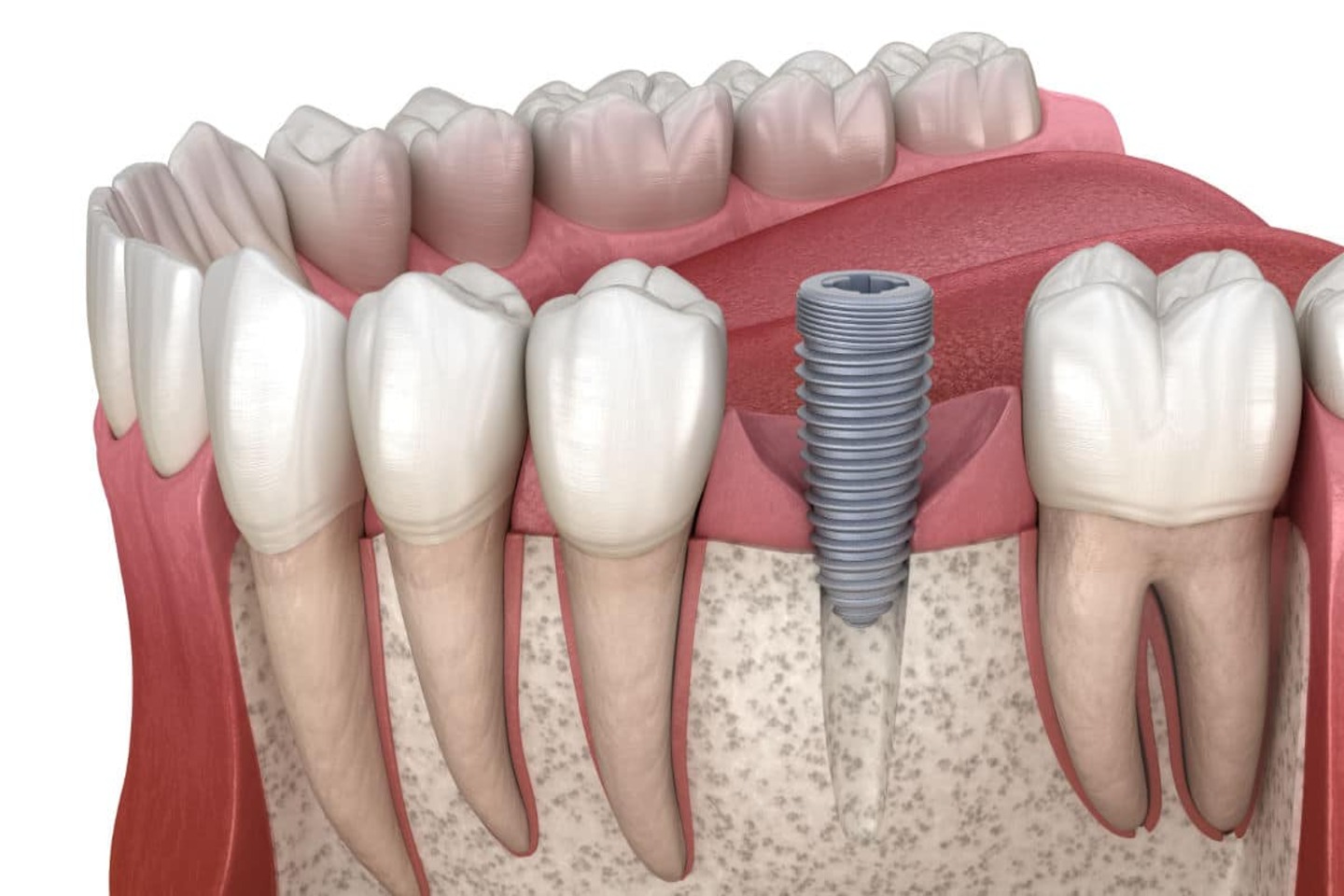 Adaptación y Osteointegración